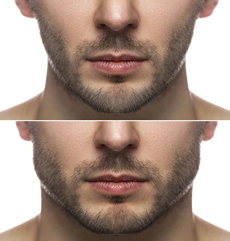 Is Wide Jaw Attractive? How Can You Look More Attractive With Jawline  Surgery? - Dr. MFO